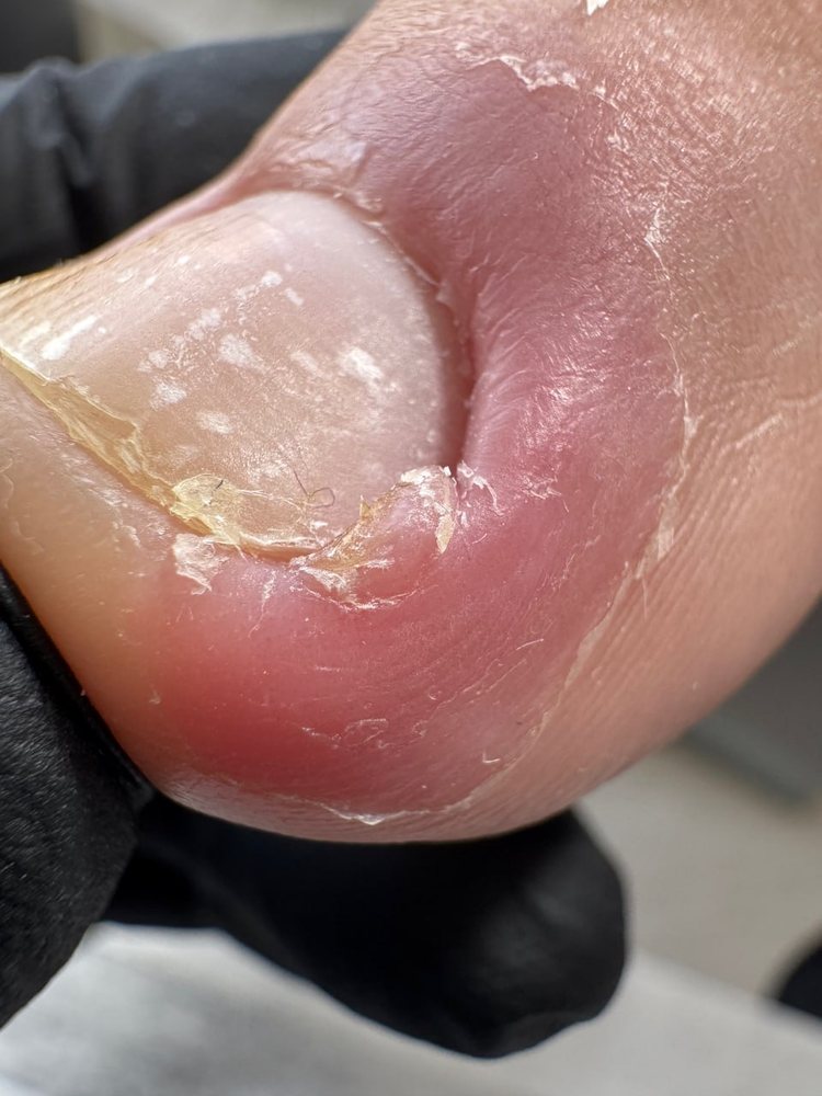 Вросшие ногти — фото из практики